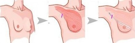 硅胶丰胸效果怎么样