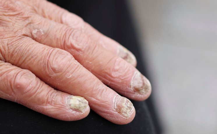 灰指甲是什么原因引起的？