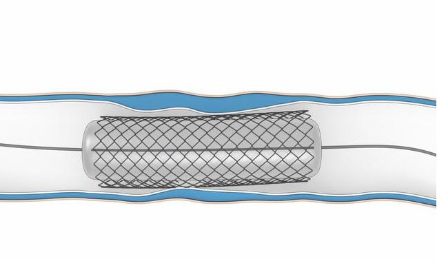 国内什么时候上市完全可降解支架