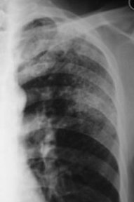 肺结核的胸片有什么特点