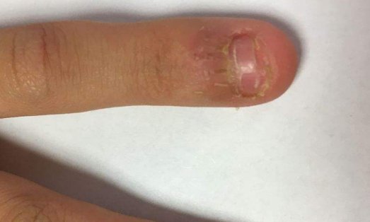 亮甲对灰指甲有用吗?