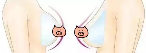 硅胶丰胸效果怎么样