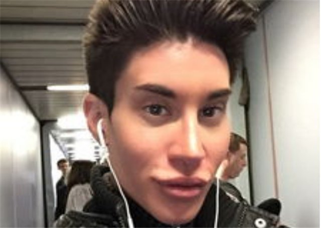 那个为追求完美，花154万在背上植入“翅膀”的小伙，现状如何？