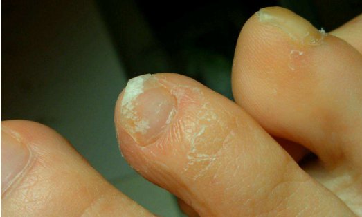 亮甲对灰指甲有用吗?