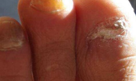 亮甲对灰指甲有用吗?