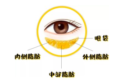 眼袋修复