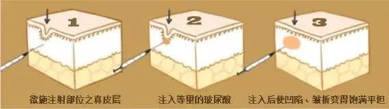 打玻尿酸可以去除抬头纹吗