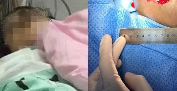 少年打麻药自宫是怎么回事?