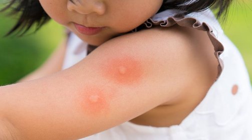 蚊子太惹人嫌了，那么蚊子最爱咬什么样的人呢？