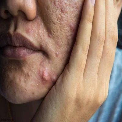 结节性痤疮怎么去除