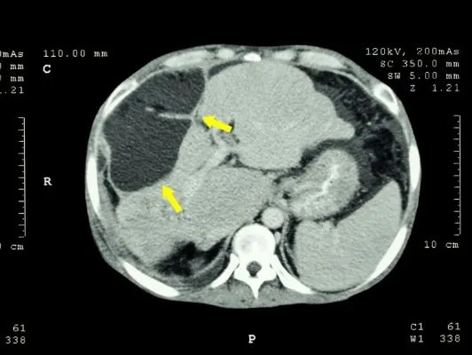 丘脑顶叶受损会怎么样