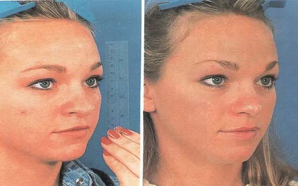 北京隆鼻哪些医院比较好？