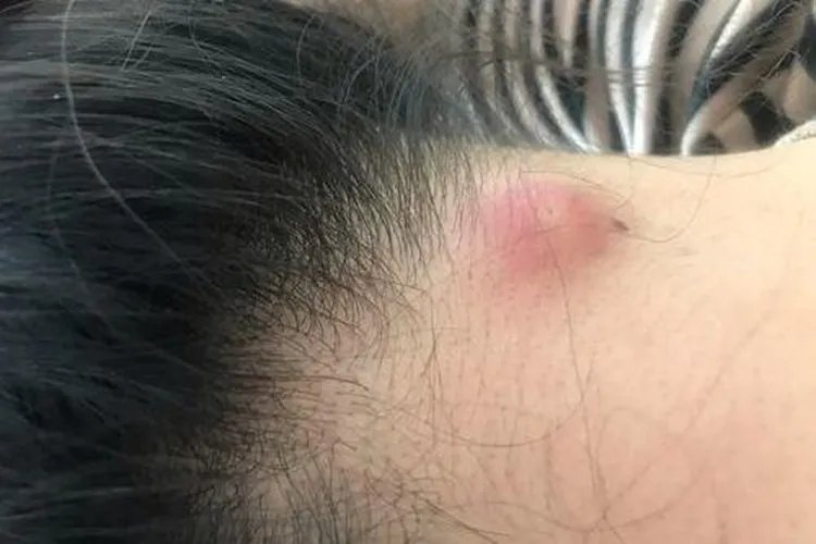 脖子上长了个疙瘩图片