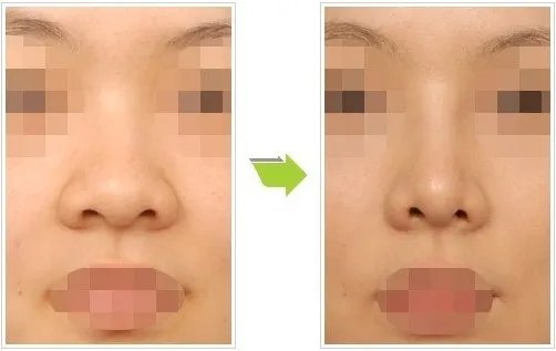 鼻翼肥大手术多少钱