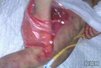 5岁儿童被虐照片虐人心 一身伤痕惨不忍睹（图）