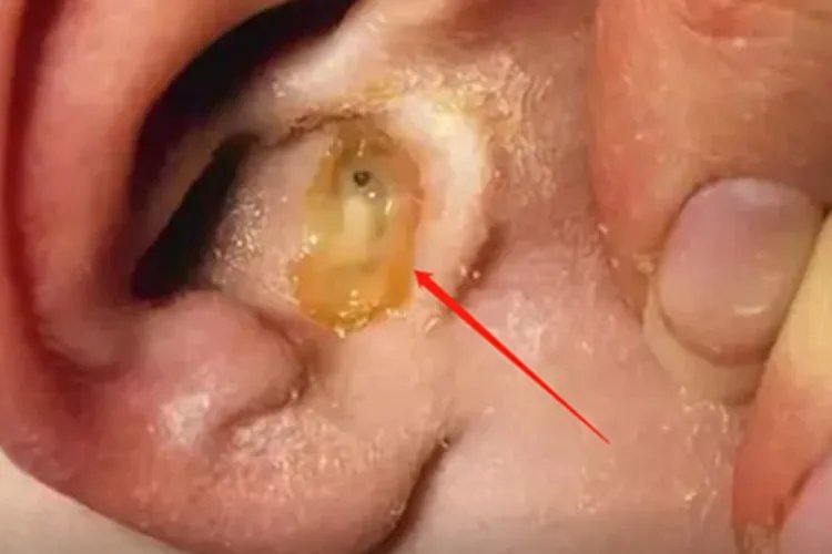 猩红热症状图片