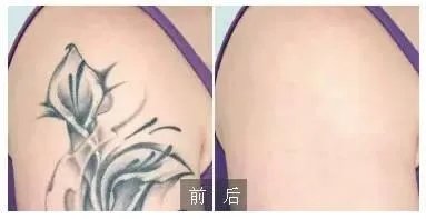 上海消除纹身多少钱