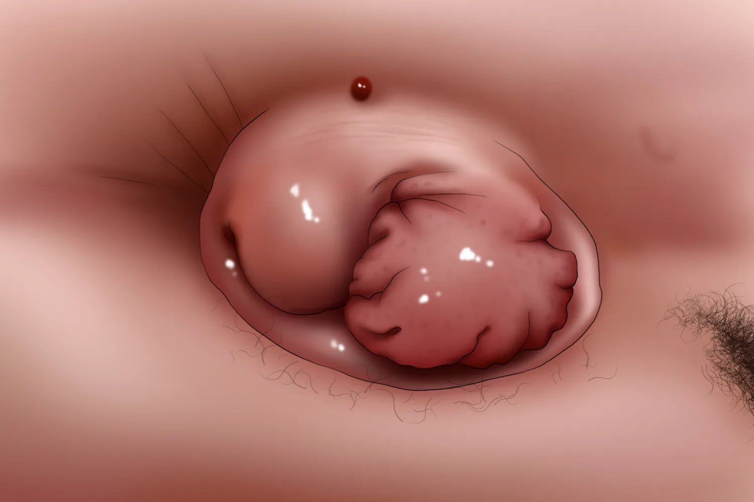 痔疮内痔是什么症状图片