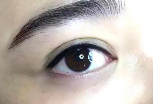 消除眼袋手术疼吗