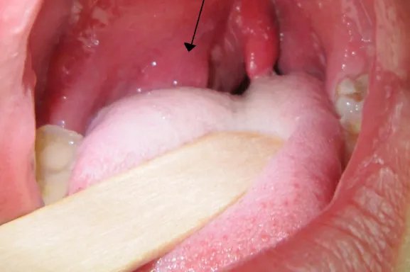 成人咽峡炎的症状图片