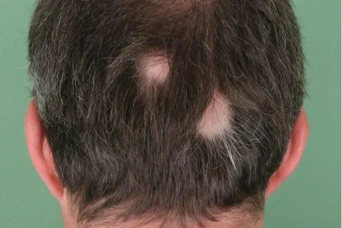 白颠疯病初期是什么样的症状