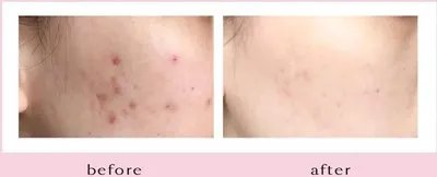 做激光治疗痤疮的费用是多少