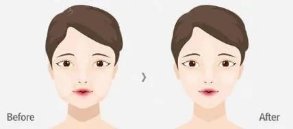 去颊脂垫术的风险是什么