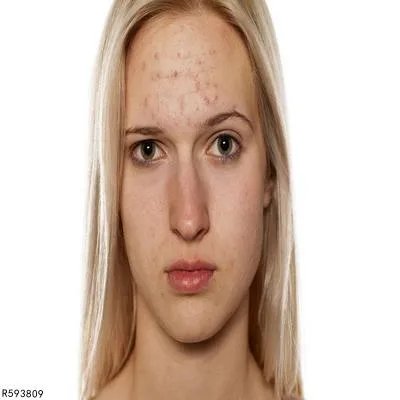 面部红血丝用什么方法可以去掉