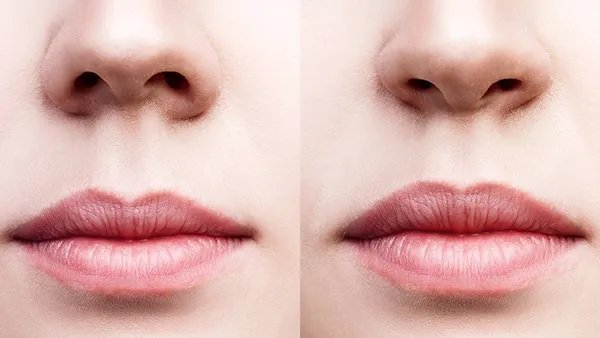 隆鼻有什么后遗症吗