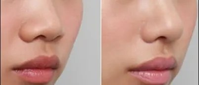 假体隆鼻修复前后对比照