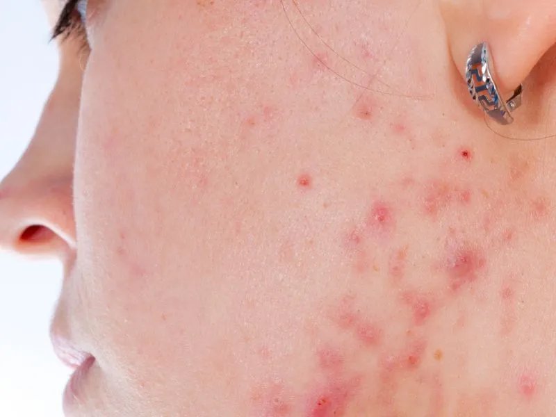 中医去痘印的方法