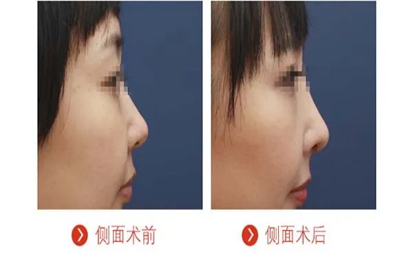 北京隆鼻哪些医院比较好？