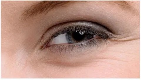 眼角鱼尾纹除皱价格是多少