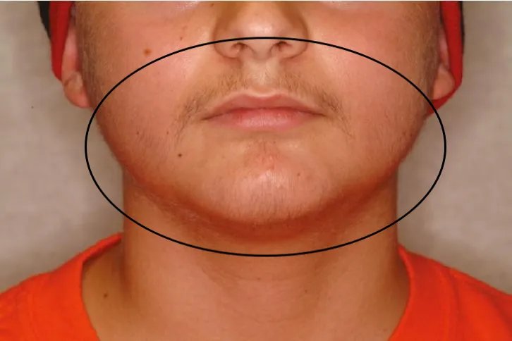 儿童性早熟症状图片