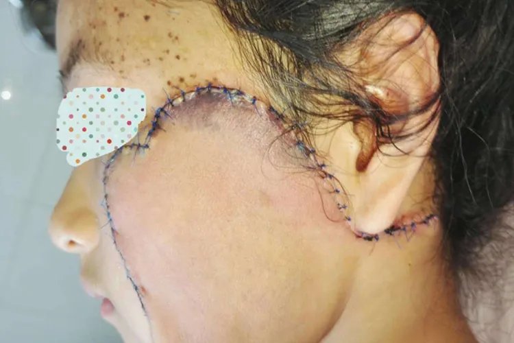 脸部植皮后恢复图片