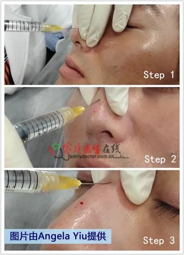 带你到香港寻找微整形新概念