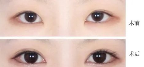 做韩式开眼角价格是多少