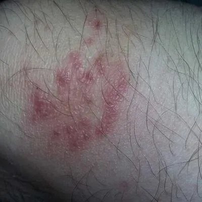 肤蝇蛆怎么治疗