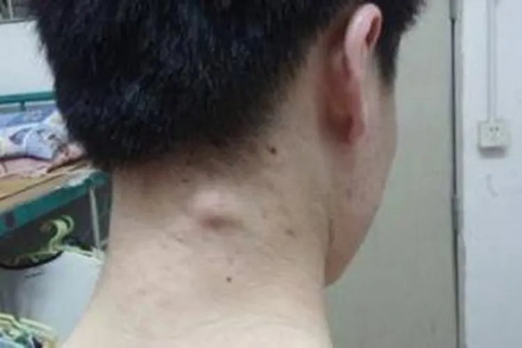 脖子上长了个疙瘩图片