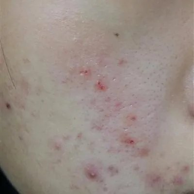 痤疮疙瘩是什么原因