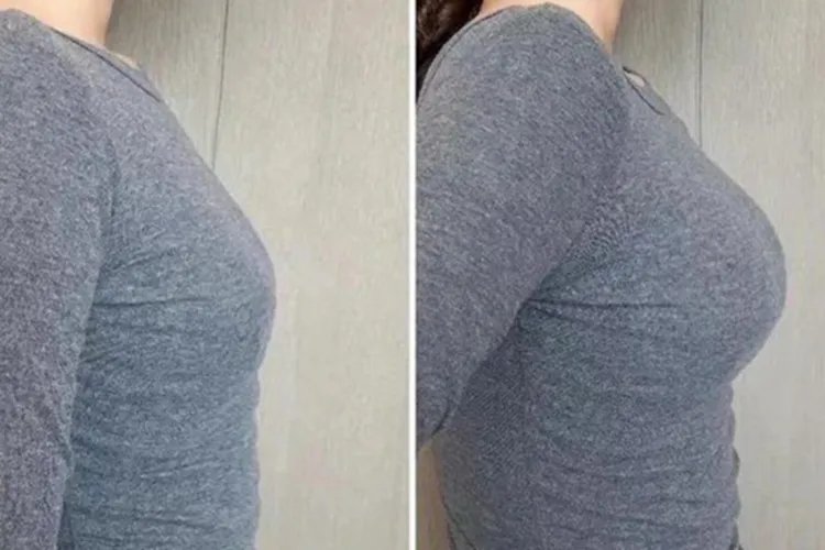 假体隆胸恢复后照片