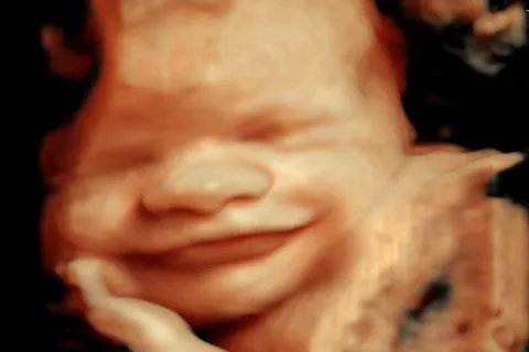 胎儿的四维彩超图片