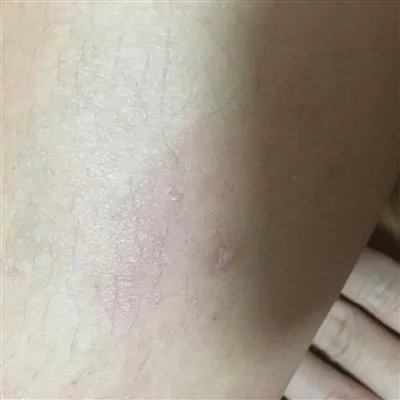 肤蝇蛆怎么治疗