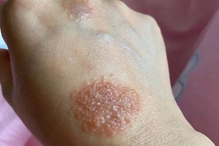 湿疹手背水疱图片