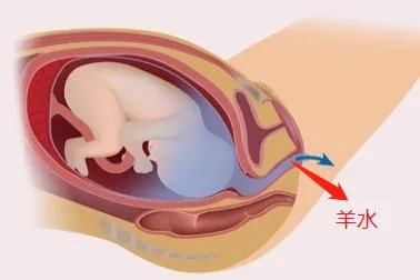 怀孕羊水破了是什么样的