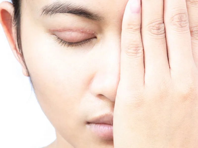 红血丝能去掉吗