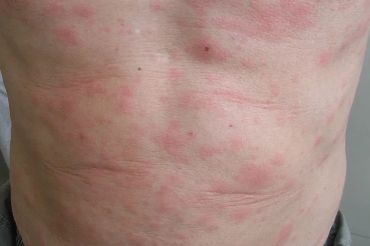 全身过敏症状图片