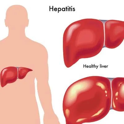 抗肝癌药品种有哪些