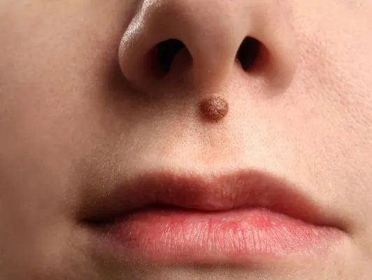 怎么去鼻唇沟纹