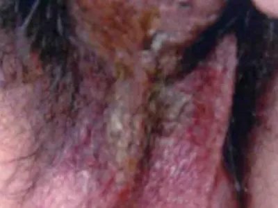 湿疹阴囊症状图片